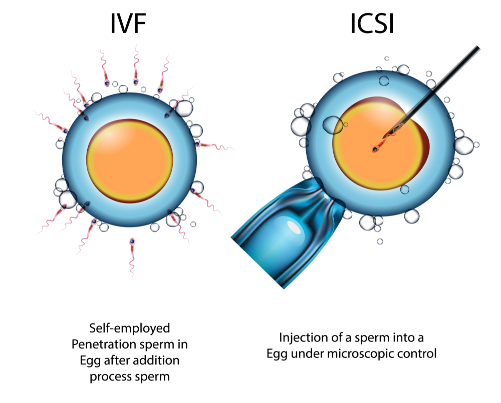 ICSI vs IVF comparison – Matrika Advanced Fertility and Laparoscopic Centre, Kondapur, Hyderabad