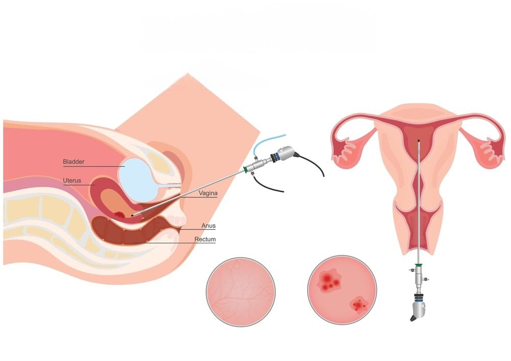 Cross-section of the female pelvis with a vaginal instrument entering the uterus; two close-ups show cervix tissue with lesions.