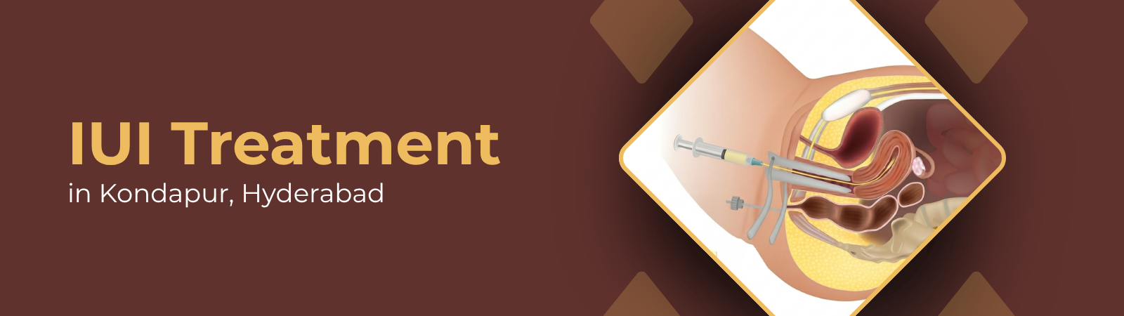 c17f14af-4db0-40f6-b0e3-0cd60bf04a0f Banner: IUI Treatment in Kondapur, Hyderabad; illustration of female reproductive organs with insemination syringes.