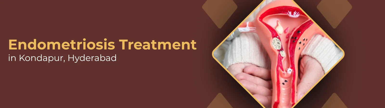Endotermesis Banner Promotional banner for endometriosis treatment in Kondapur, Hyderabad, featuring a uterus model held in hands within a diamond frame.