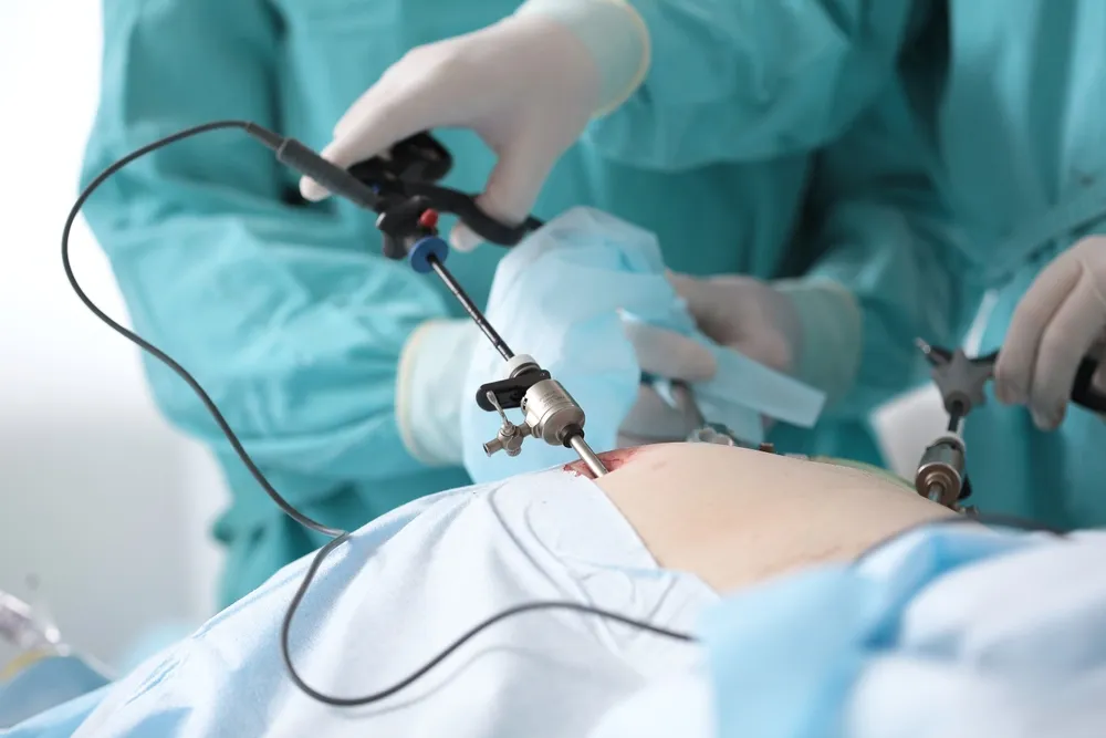 Laproscopy Surgeon in teal scrubs performing a minimally invasive operation with laparoscopic instruments inserted into the patient.